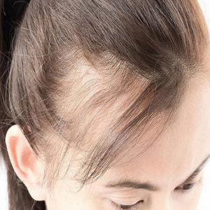 which-vitamin-deficiencies-causes-hair-loss